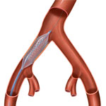 iliac artery - Angioplasty / Stenting
