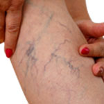 Foam Sclerotherapy for Varicose Veins