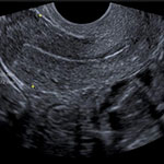 Transvaginal Ultrasound Scan