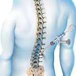 Spine - Disc Surgery