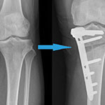 High Tibial Osteotomy, Distal Femur Osteotomy
