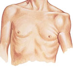 Recurrent Dislocations of Shoulder