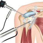 Shoulder Joint Replacement Surgery