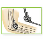 Elbow Joint Replacement Surgery Procedure
