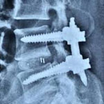 Spine Instrumentation Stabilisation