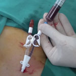 HD Catheter Insertion