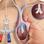 Tunneled  HD Catheter Insertion