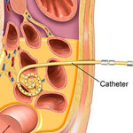 CAPD Catheter Placement