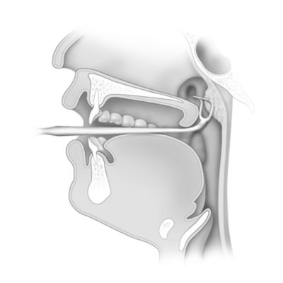 What can you expect after an adenoidectomy?