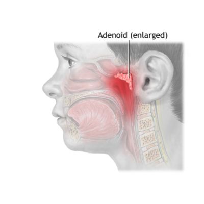 When is an adenoidectomy required?