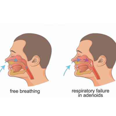 What happens during adenoidectomy treatment?