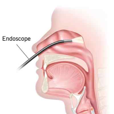 Endoscopic DCR