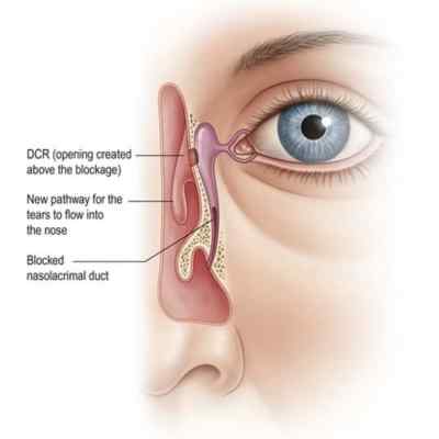 What is dacryocystorhinostomy?