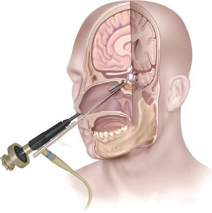 How to prepare for Endoscopic Pituitary Tumour Excision Surgery