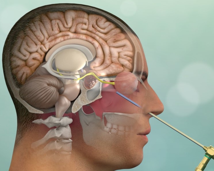 What can you expect after an Endoscopic Pituitary Tumour Excision?