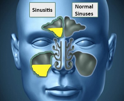 Endoscopic Sinus Surgery (FESS)